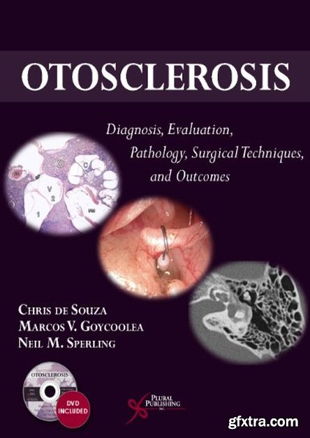 Otosclerosis: Diagnosis, Evaluation, Pathology, Surgical Techniques, and Outcomes