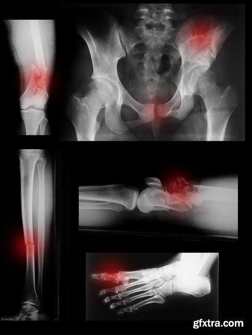 Stock Photos - X-ray, Roentgenogram, 25xJPG