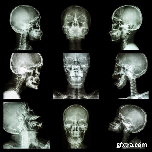 Stock Photos - X-ray, Roentgenogram, 25xJPG