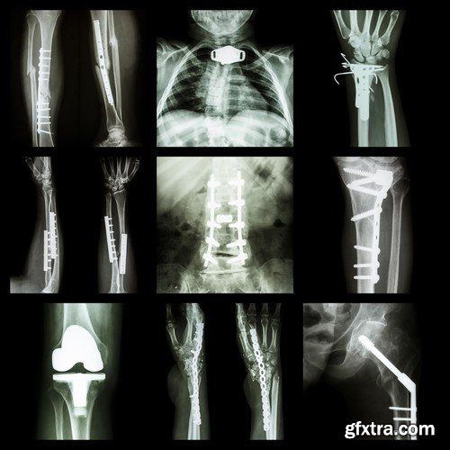 Stock Photos - X-ray, Roentgenogram, 25xJPG