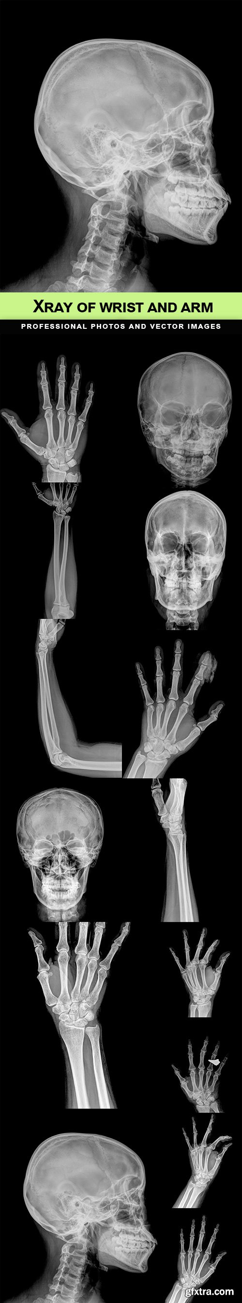 Xray of wrist and arm - 14 UHQ JPEG