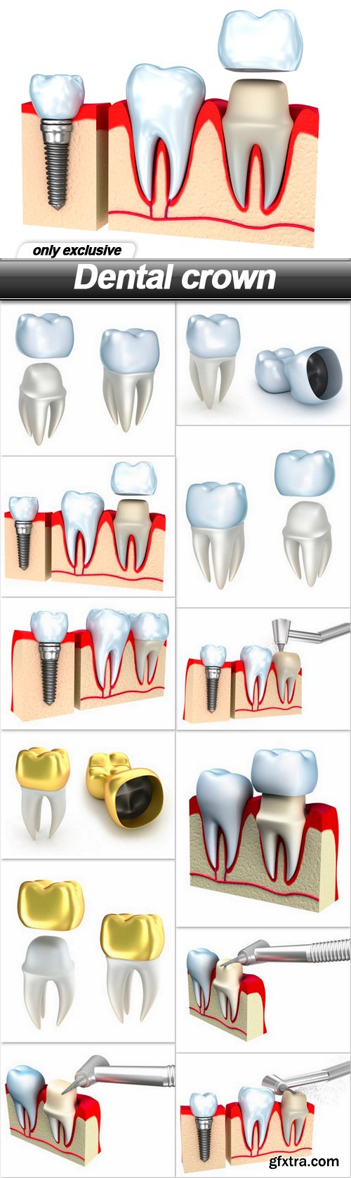 Dental crown - 12 UHQ JPEG