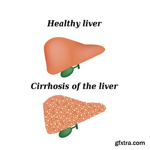 Cirrhosis of liver-5xJPEGs