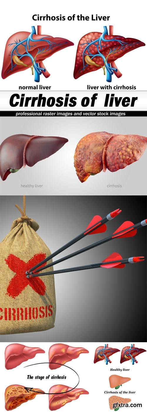 Cirrhosis of liver-5xJPEGs