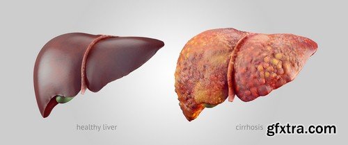 Cirrhosis of liver-5xJPEGs