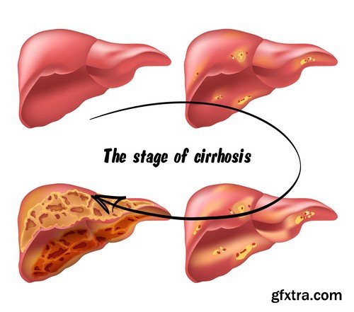 Cirrhosis of liver-5xJPEGs