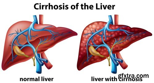 Cirrhosis of liver-5xJPEGs