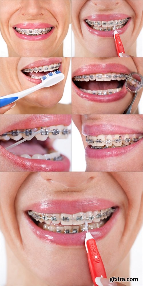 Female patient showing her lingual braces