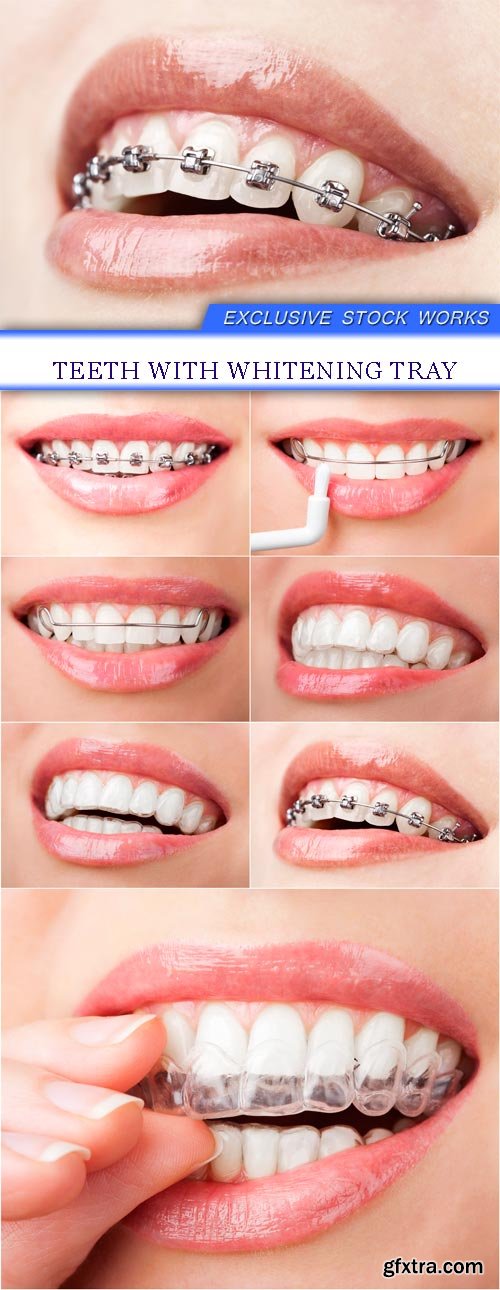 teeth with whitening tray 7X JPEG