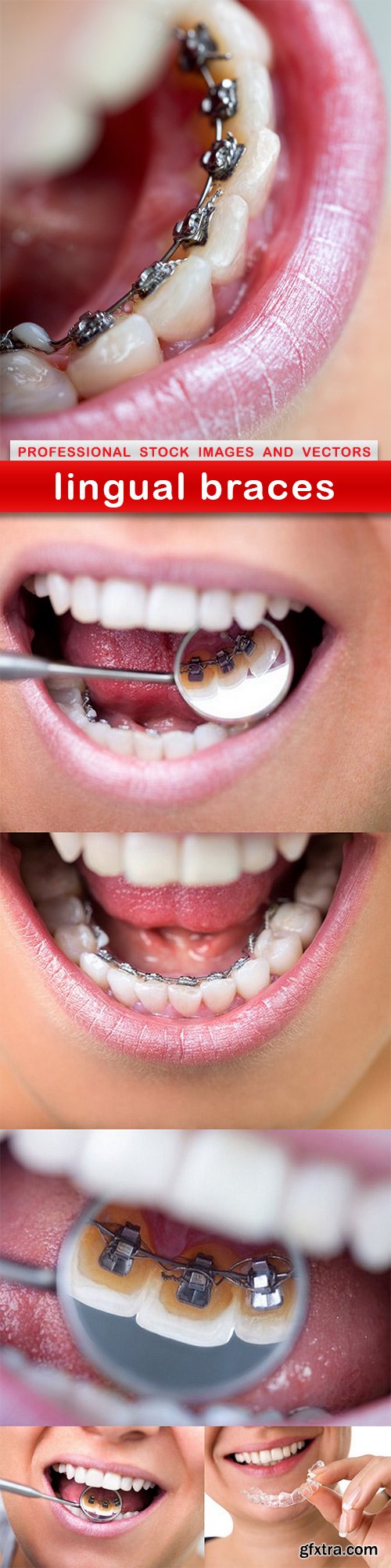 lingual braces - 6 UHQ JPEG