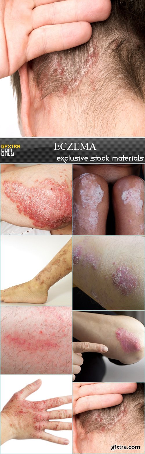 eczema - 8 JPRGs