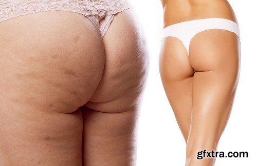 Problem of cellulite - 6 UHQ JPEG