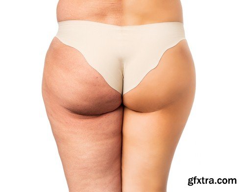 Problem of cellulite - 6 UHQ JPEG