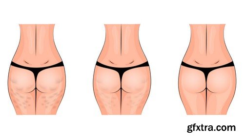 Problem of cellulite - 6 UHQ JPEG