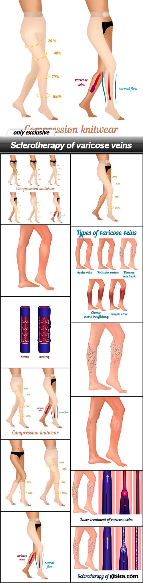 Sclerotherapy of varicose veins - 12 EPS