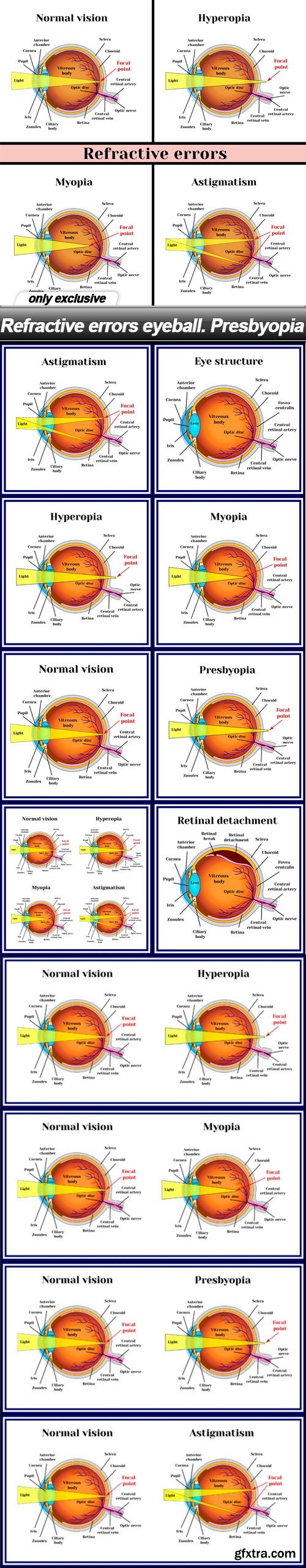 Refractive errors eyeball. Presbyopia - 13 EPS