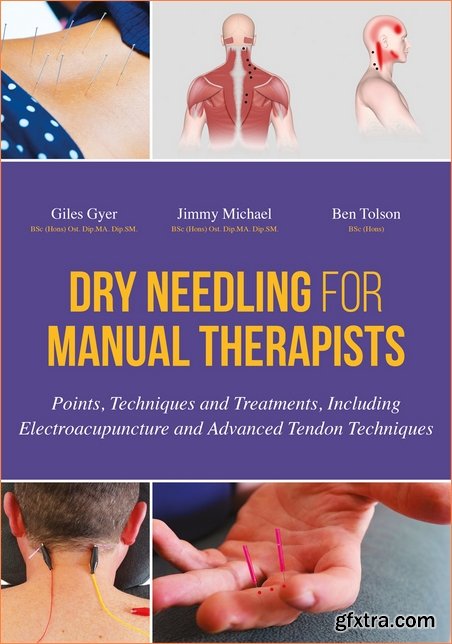 Dry Needling for Manual Therapists: Points, Techniques and Treatments, Including Electroacupuncture and Advanced Tendon Techniques