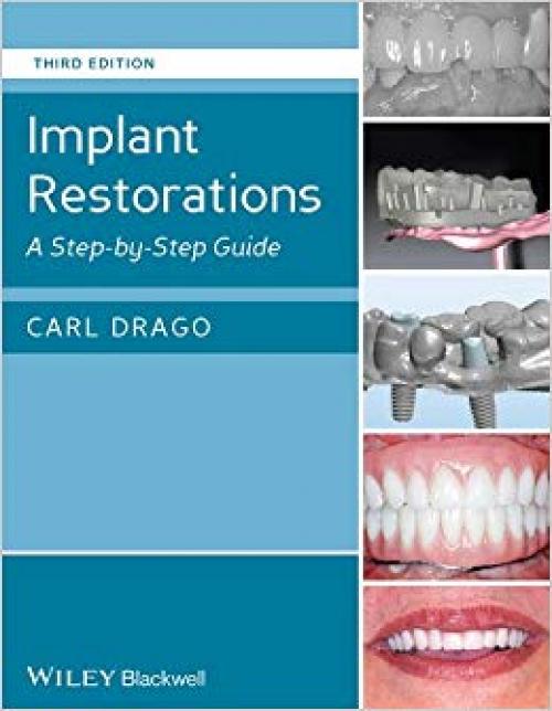 Implant Restorations: A Step-by-Step Guide - 1118513053