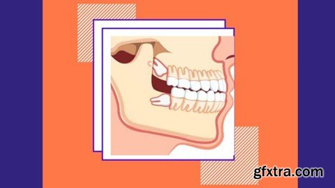 Extraction of Impacted Third Molar