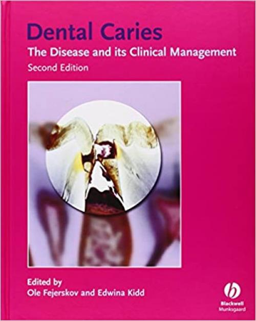  Dental Caries: The Disease and Its Clinical Management 