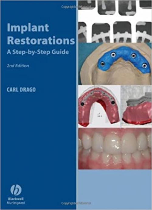  Implant Restorations: A Step-by-Step Guide 