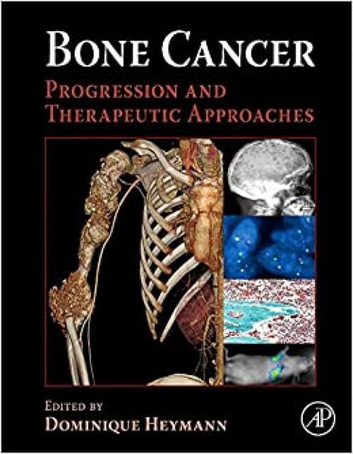  Bone Cancer: Progression and Therapeutic Approaches 