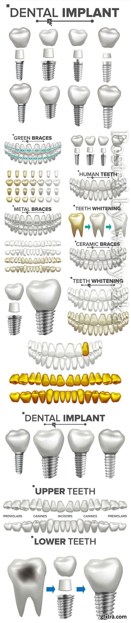 Dental implant illustration vector set