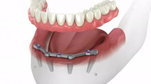 Videohive - Mandibular prosthesis with gum All on 4 system supported by implants - 43254792 - 43254792