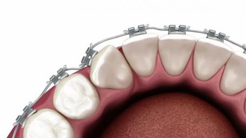 Videohive - Cuspid correction with braces. Medically accurate dental 3D illustration - 43253871 - 43253871