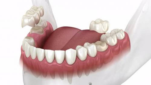 Videohive - Installation of dental bridge and single crown - 43254790 - 43254790