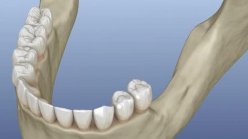 Videohive - Implantation with mini implants in to recessed jaw bone: Medically accurate 3D animation - 43220629 - 43220629