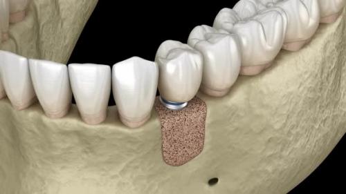 Videohive - Augmentation Surgery - Adding new bone and implant. - 43225737 - 43225737