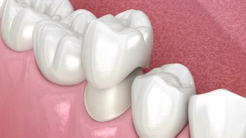 Videohive - Preparated premolar tooth for dental ceramic crown placement. - 43236472 - 43236472