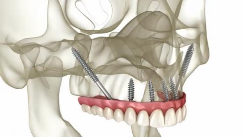 Videohive - Maxillary and Mandibular prosthesis supported by zygomatic implants - 43253889 - 43253889