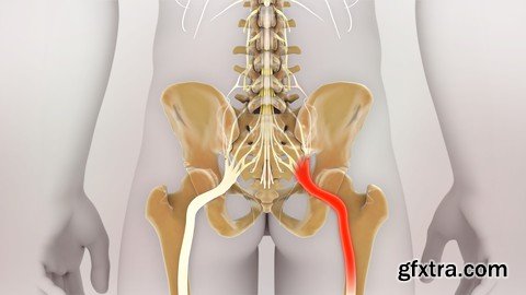 How to fix Sciatica at home?