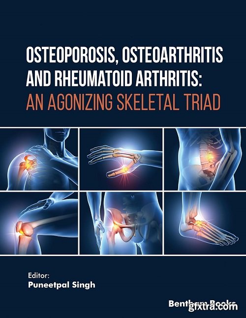 Osteoporosis, Osteoarthritis and Rheumatoid Arthritis: An Agonizing Skeletal Triad