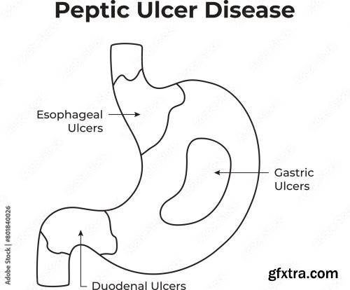 Peptic Ulcer Disease Science Design Vector Illustration 5xAI