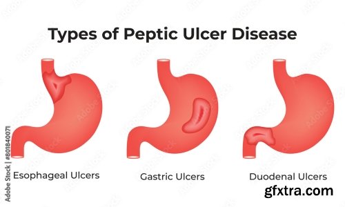 Peptic Ulcer Disease Science Design Vector Illustration 5xAI