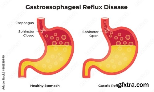 Peptic Ulcer Disease Science Design Vector Illustration 5xAI