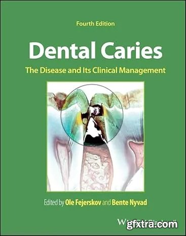 Dental Caries: The Disease and its Clinical Management, 4th Edition