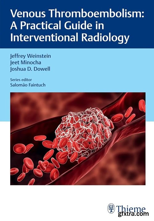 Venous Thromboembolism: A Practical Guide in Interventional Radiology